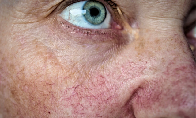 COUPEROSE: Tettstilte, små, sprukne blodkar i ansikt kalles for couperose. FOTO: NTB Scanpix / Shutterstock / Svetlana Dolgova COUPEROSE: Tettstilte, små, sprukne blodkar i ansikt kalles for couperose. FOTO: NTB Scanpix / Shutterstock / Svetlana Dolgova